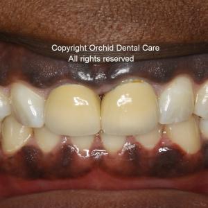 Before picture of  teeth treated with cosmetic full ceramic crowns 